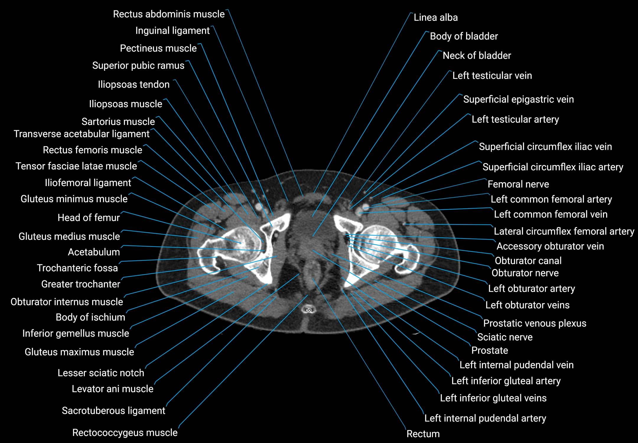 CT male pelvis axial cross sectional anatomy labelled radiology image -00192.webp